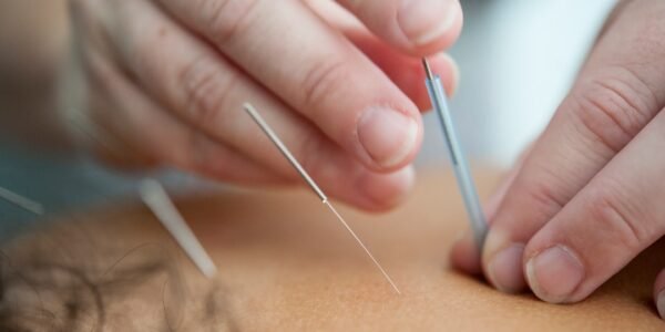 Acupuncture Benefits and Risks: What You Need to Know