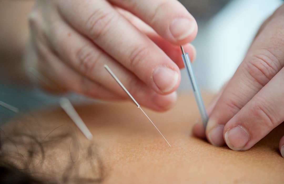 Acupuncture Benefits and Risks: What You Need to Know
